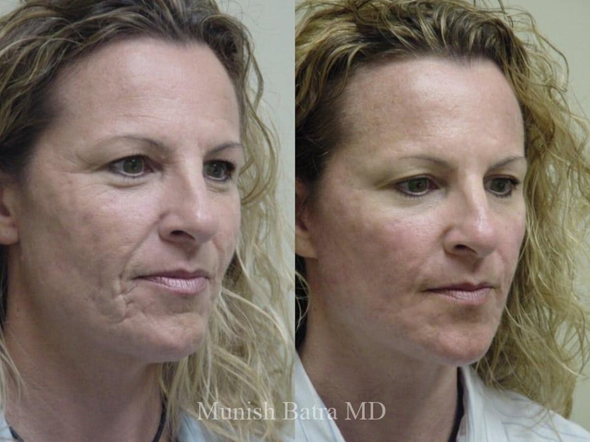 Facelift Before & After Gallery - Patient 211631 - Image 2