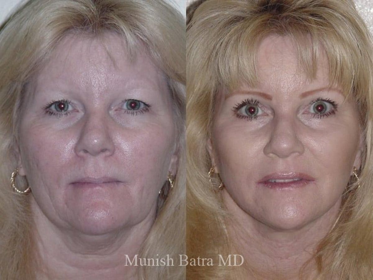 Facelift Before & After Gallery - Patient 182850 - Image 1