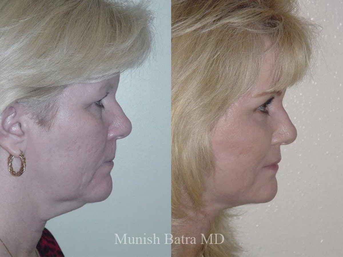 Facelift Before & After Gallery - Patient 182850 - Image 2