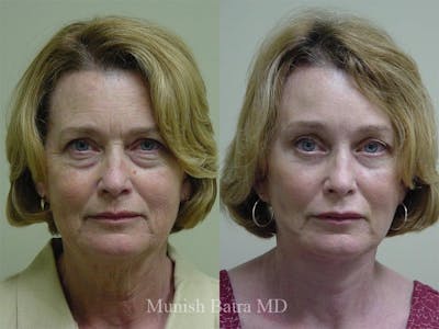 Facelift Before & After Gallery - Patient 281942 - Image 1