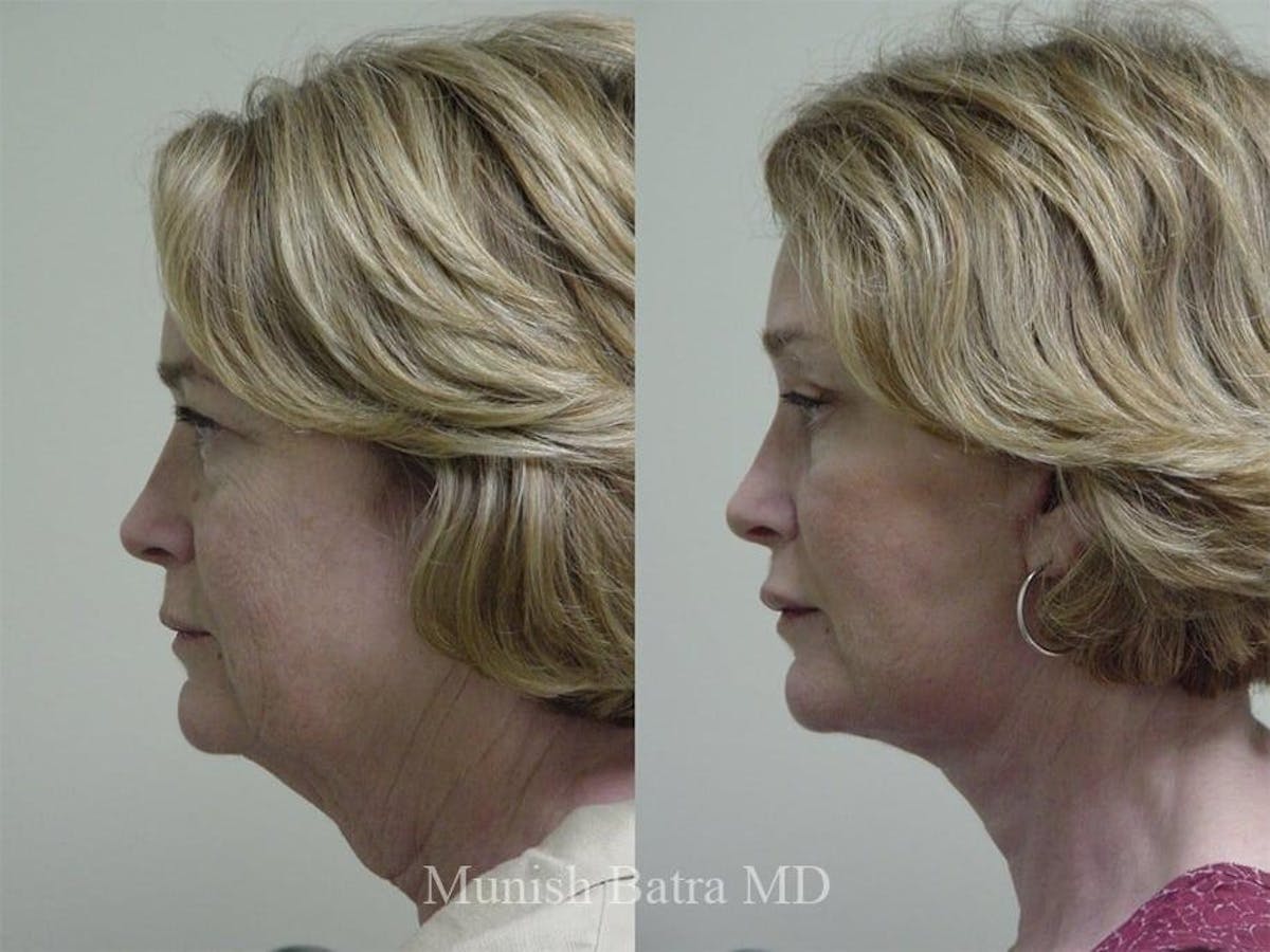 Facelift Before & After Gallery - Patient 281942 - Image 2