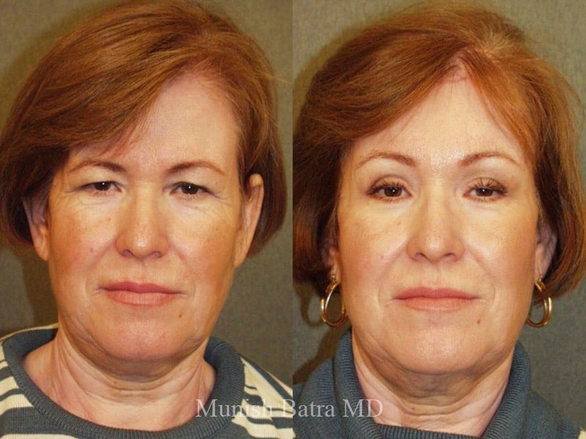 Facelift Before & After Gallery - Patient 258636 - Image 1