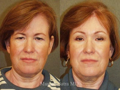 Facelift Before & After Gallery - Patient 258636 - Image 1