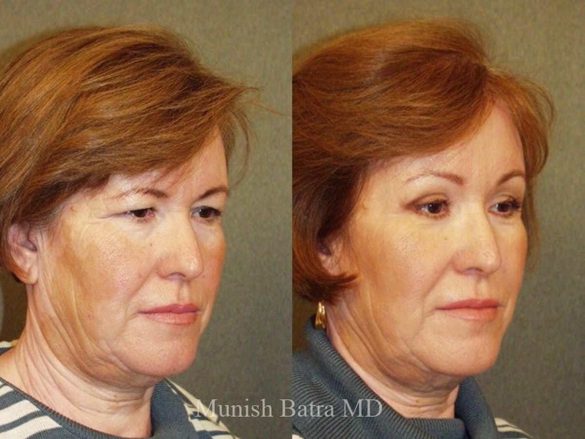 Facelift Before & After Gallery - Patient 258636 - Image 2
