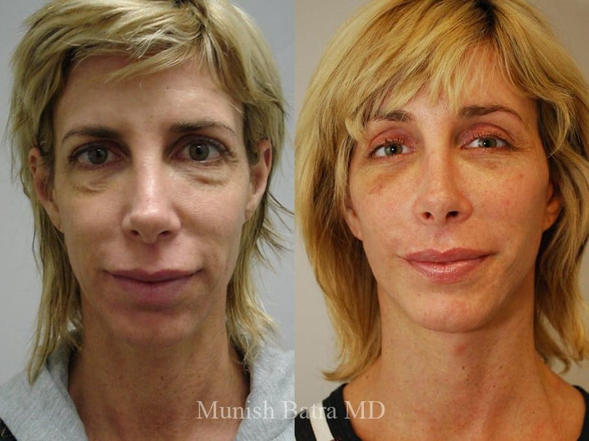 Facelift Before & After Gallery - Patient 233175 - Image 1