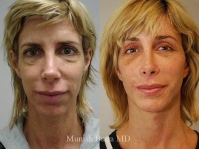 Facelift Before & After Gallery - Patient 233175 - Image 1
