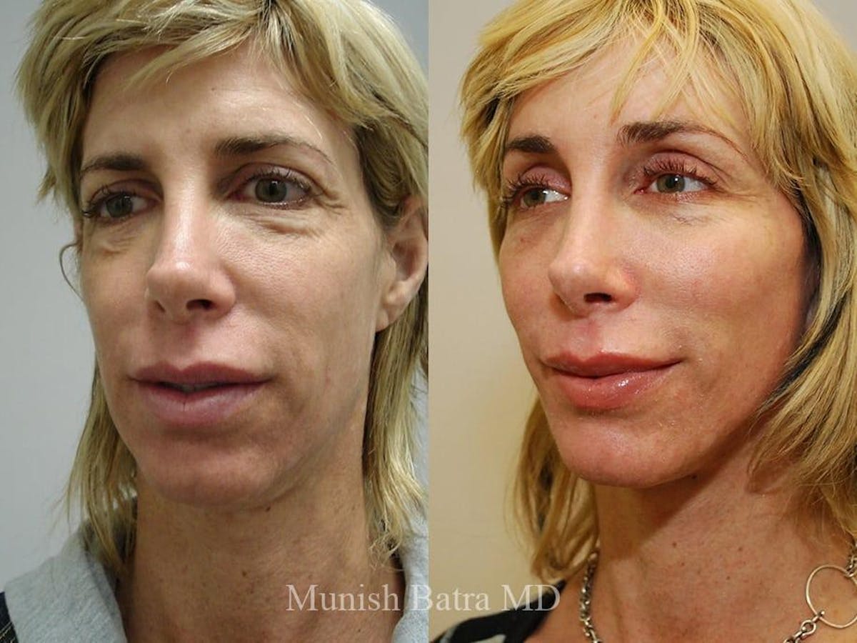 Facelift Before & After Gallery - Patient 233175 - Image 2