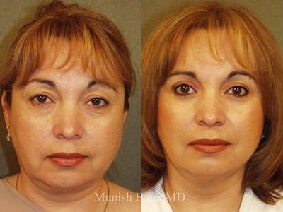 Facelift Before & After Gallery - Patient 218377 - Image 1