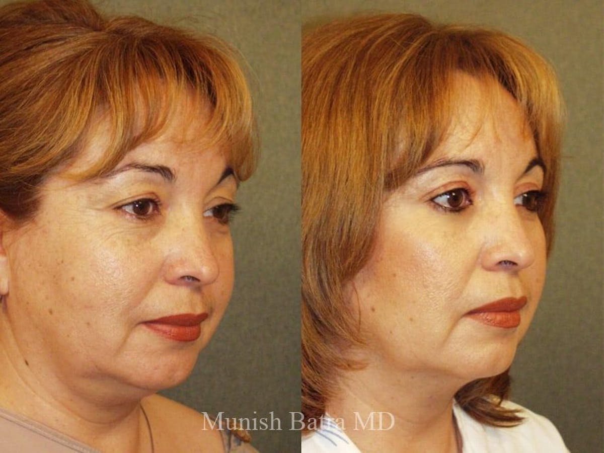 Facelift Before & After Gallery - Patient 218377 - Image 2