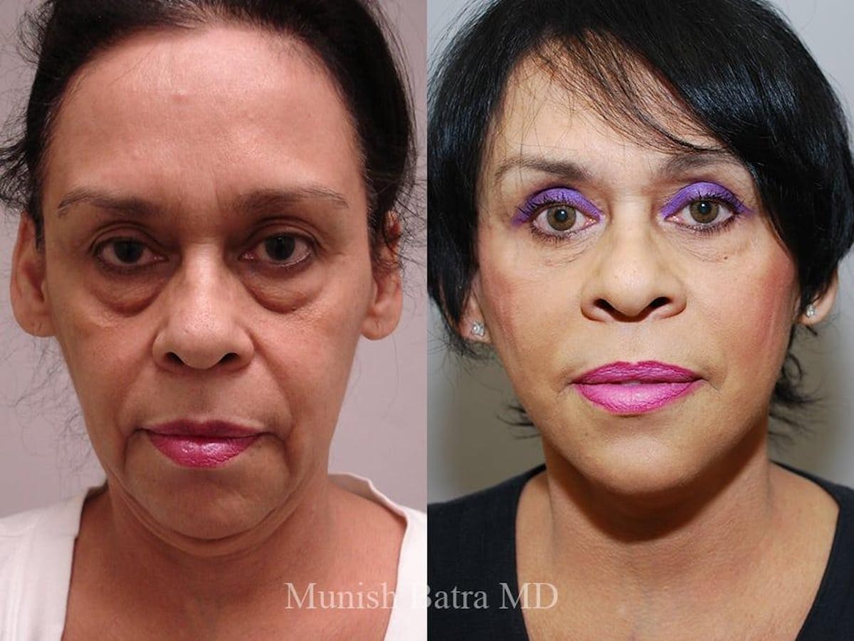 Facelift Before & After Gallery - Patient 392967 - Image 1