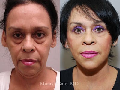 Facelift Before & After Gallery - Patient 392967 - Image 1