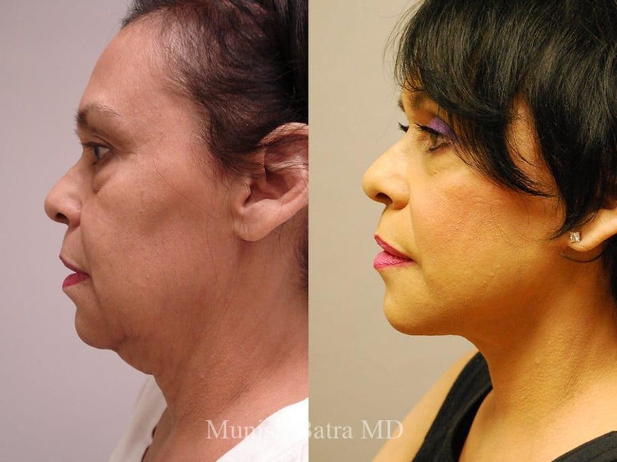 Facelift Before & After Gallery - Patient 392967 - Image 2