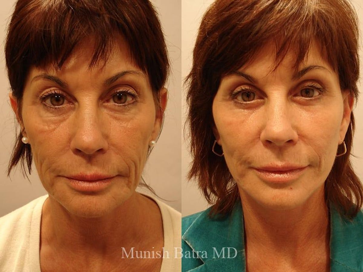 Facelift Before & After Gallery - Patient 302559 - Image 1