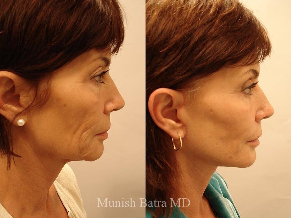 Facelift Before & After Gallery - Patient 302559 - Image 2