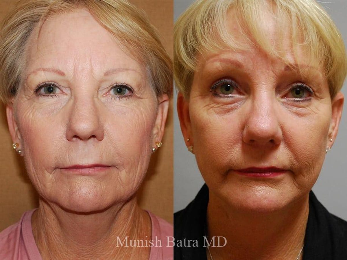 Facelift Before & After Gallery - Patient 387009 - Image 1
