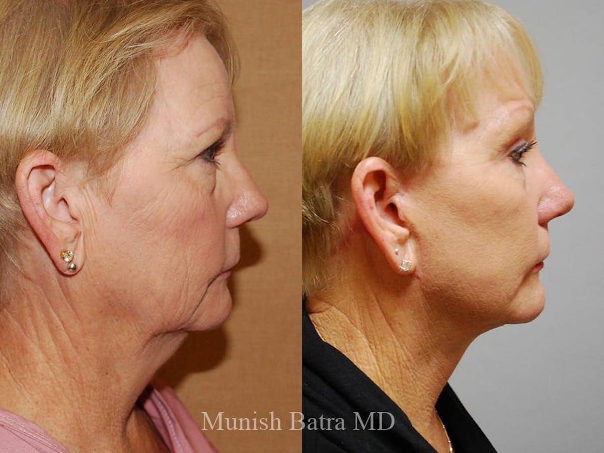 Facelift Before & After Gallery - Patient 387009 - Image 2
