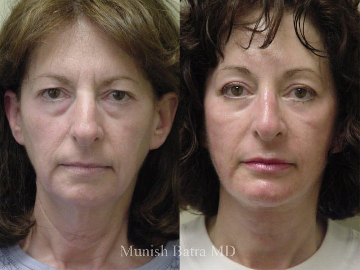 Facelift Before & After Gallery - Patient 215535 - Image 1