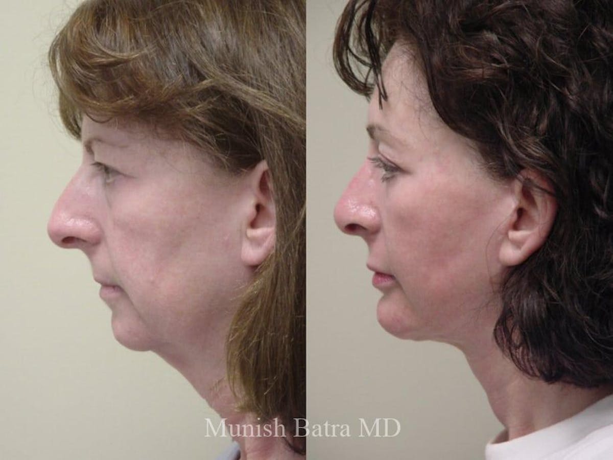 Facelift Before & After Gallery - Patient 215535 - Image 2