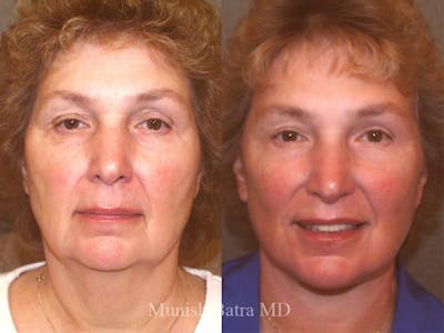 Facelift Before & After Gallery - Patient 185833 - Image 1