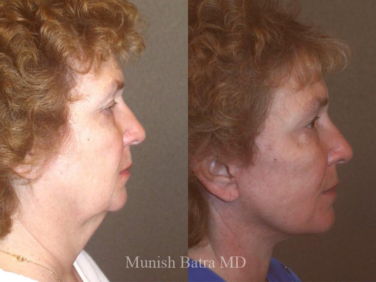 Facelift Before & After Gallery - Patient 185833 - Image 2