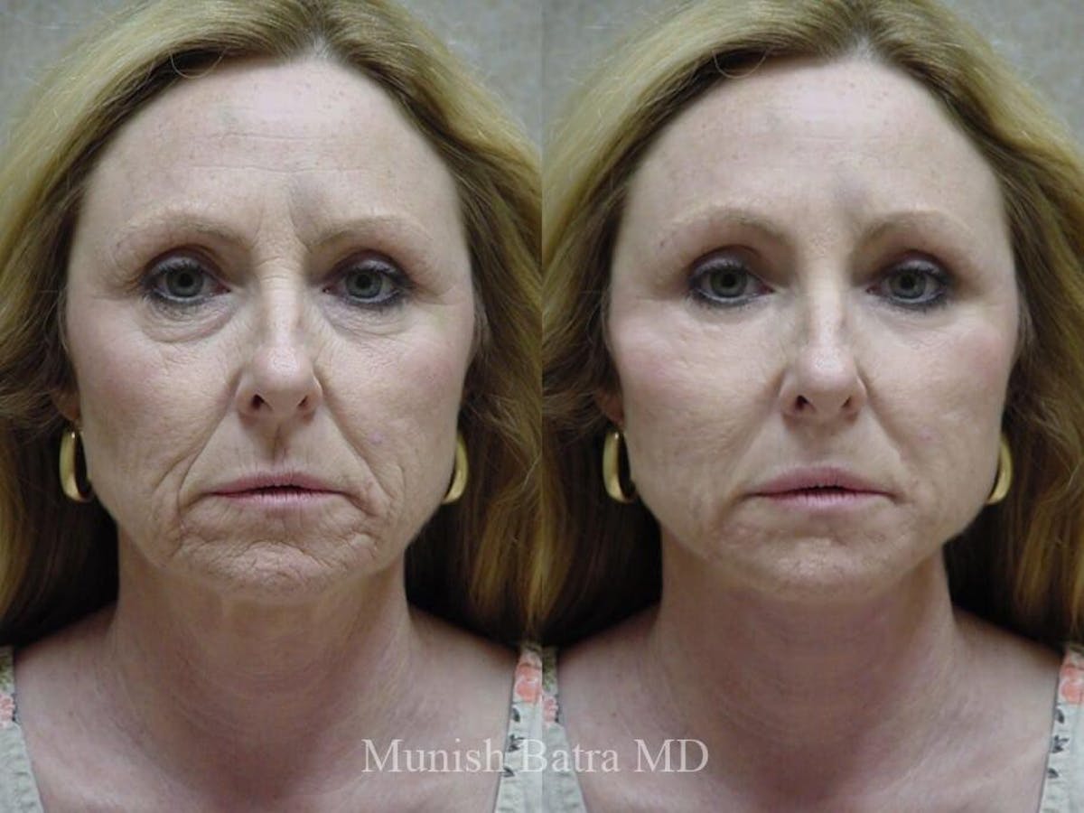Facelift Before & After Gallery - Patient 363056 - Image 1