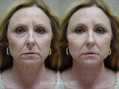 Facelift Before & After Gallery - Patient 363056 - Image 1