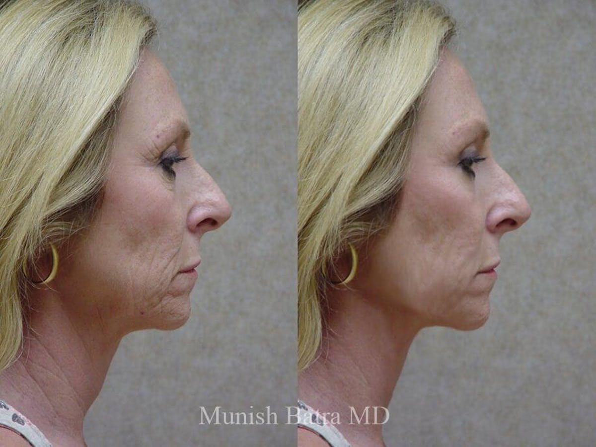 Facelift Before & After Gallery - Patient 363056 - Image 2