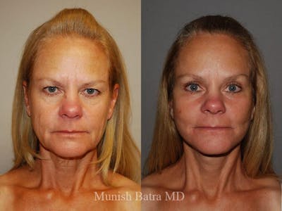 Facelift Before & After Gallery - Patient 302032 - Image 1