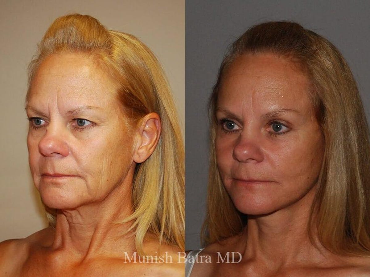 Facelift Before & After Gallery - Patient 302032 - Image 2
