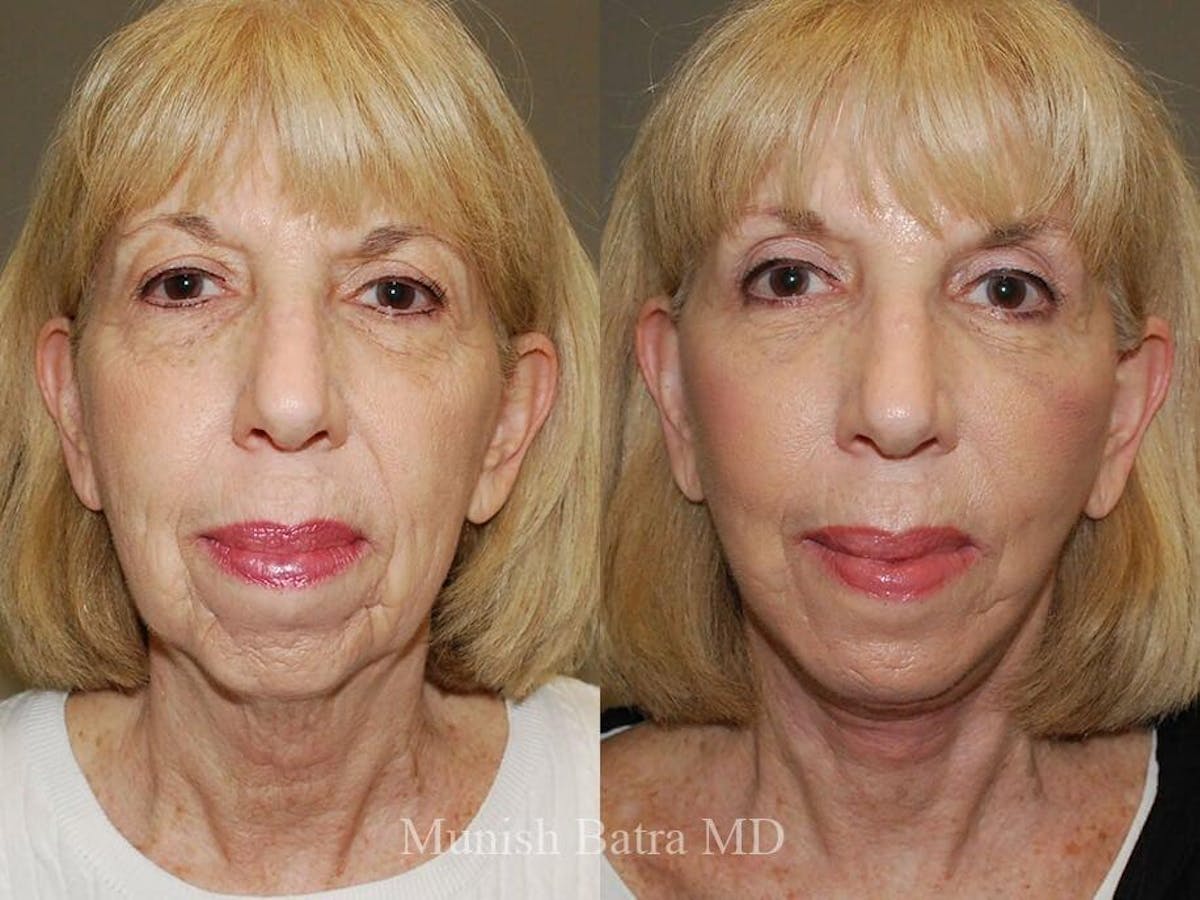 Facelift Before & After Gallery - Patient 368802 - Image 1