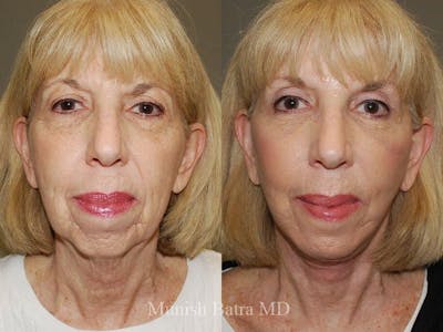 Facelift Before & After Gallery - Patient 368802 - Image 1