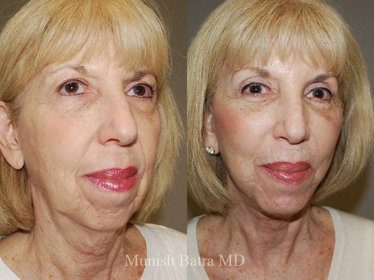 Facelift Before & After Gallery - Patient 368802 - Image 2