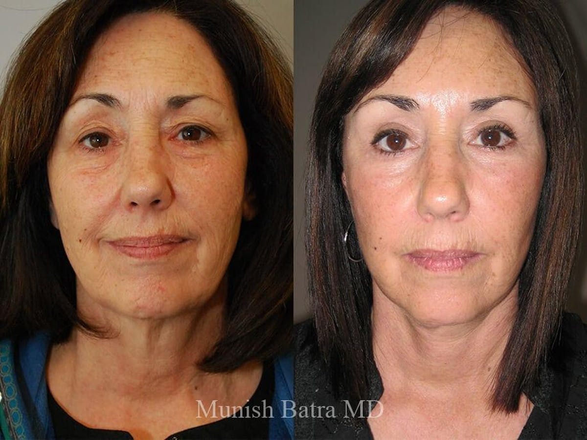 Facelift Before & After Gallery - Patient 119652 - Image 1