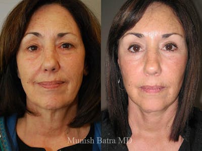 Facelift Before & After Gallery - Patient 119652 - Image 1