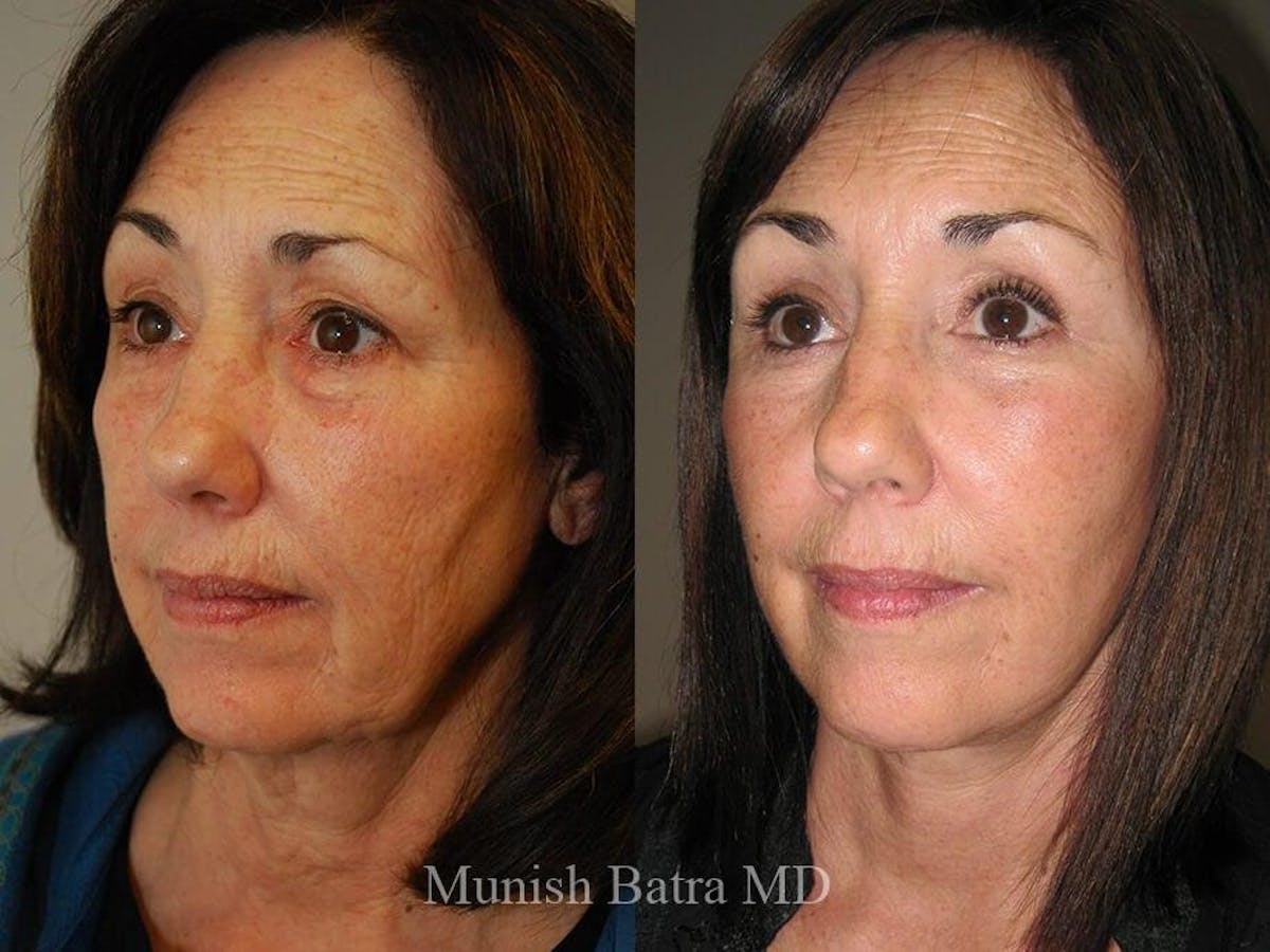 Facelift Before & After Gallery - Patient 119652 - Image 2