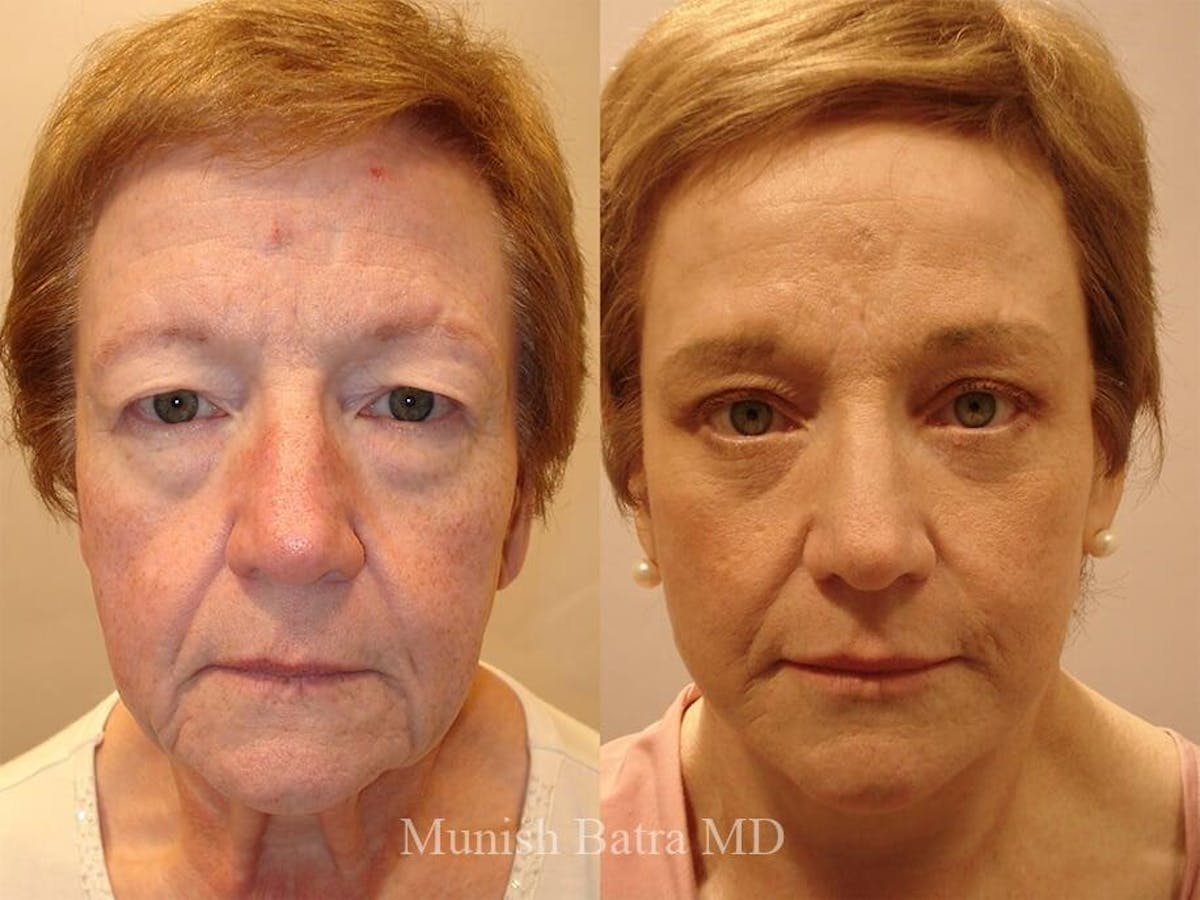 Facelift Before & After Gallery - Patient 381554 - Image 1