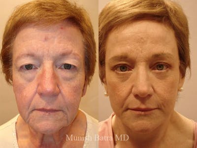 Facelift Before & After Gallery - Patient 381554 - Image 1
