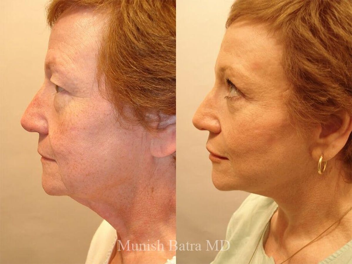 Facelift Before & After Gallery - Patient 381554 - Image 2