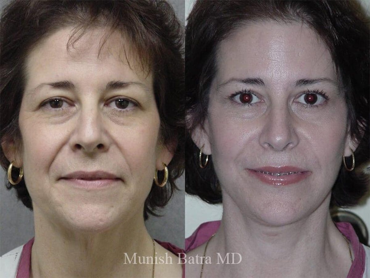 Facelift Before & After Gallery - Patient 268656 - Image 1