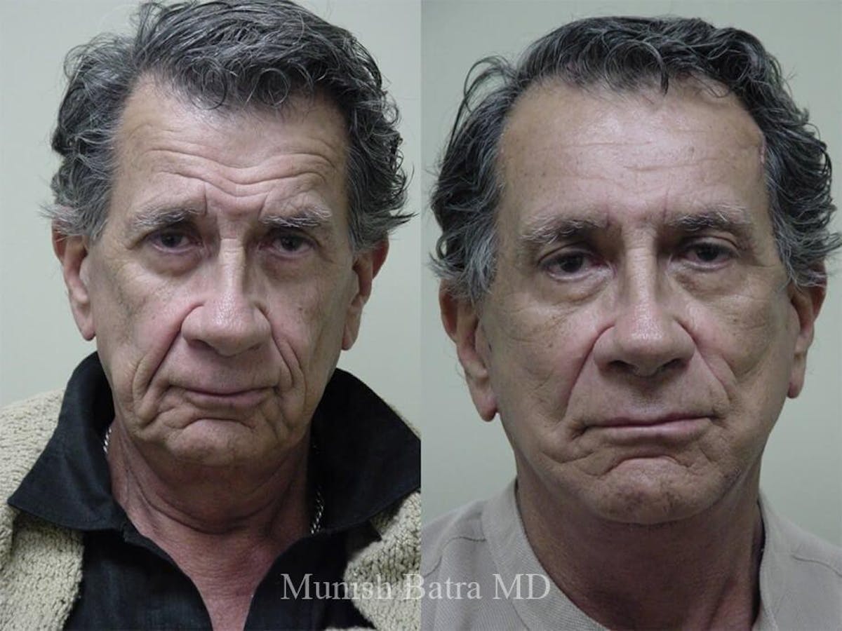 Facelift Before & After Gallery - Patient 225962 - Image 1
