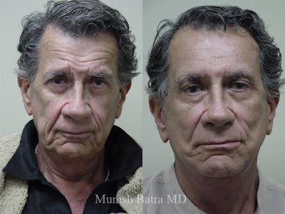 Facelift Before & After Gallery - Patient 225962 - Image 1