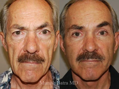Facelift Before & After Gallery - Patient 195091 - Image 1
