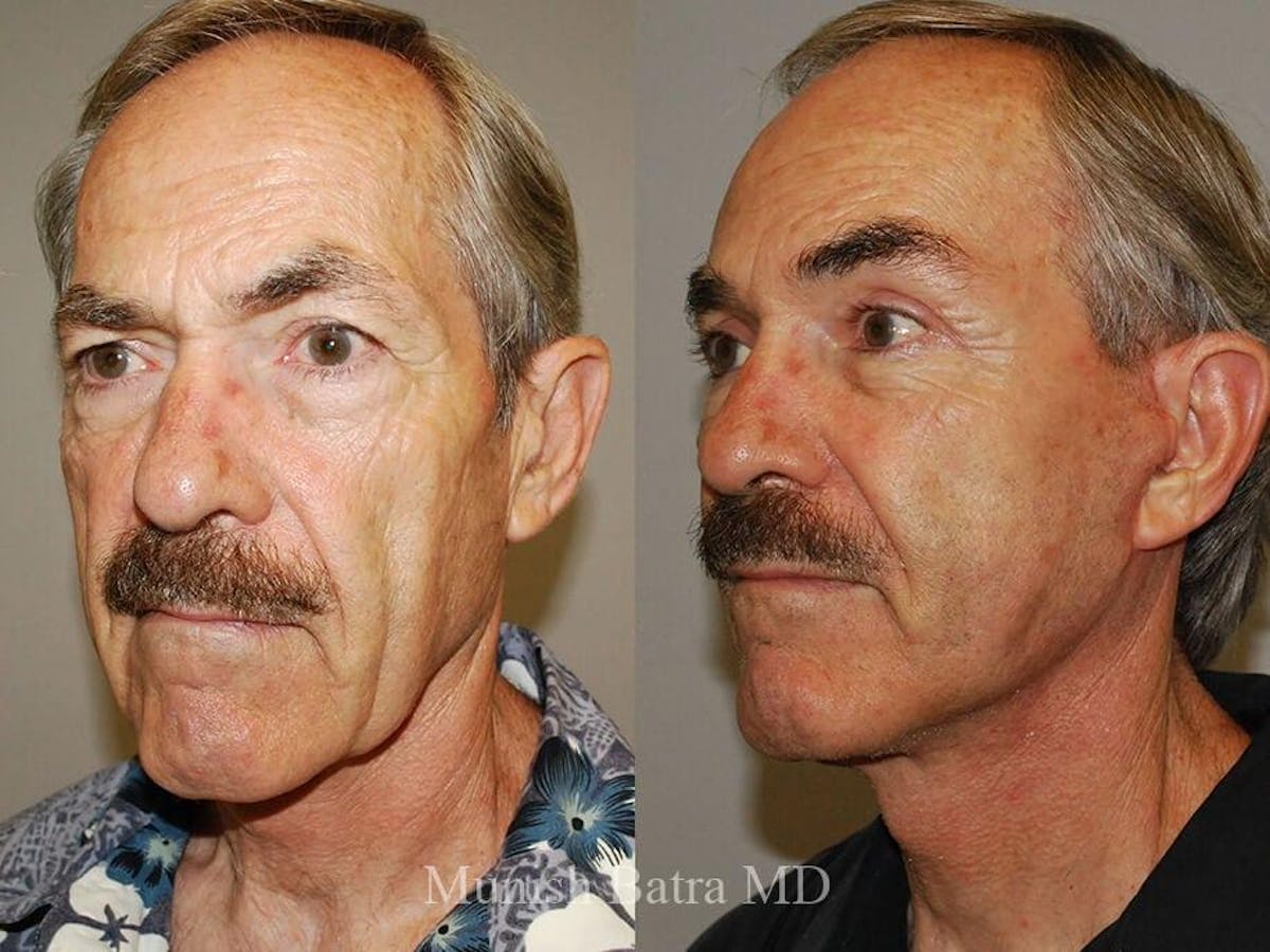 Facelift Before & After Gallery - Patient 195091 - Image 2