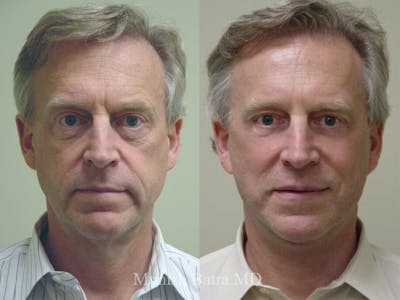 Facelift Before & After Gallery - Patient 140956 - Image 1