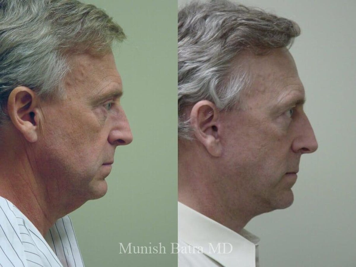 Facelift Before & After Gallery - Patient 140956 - Image 2