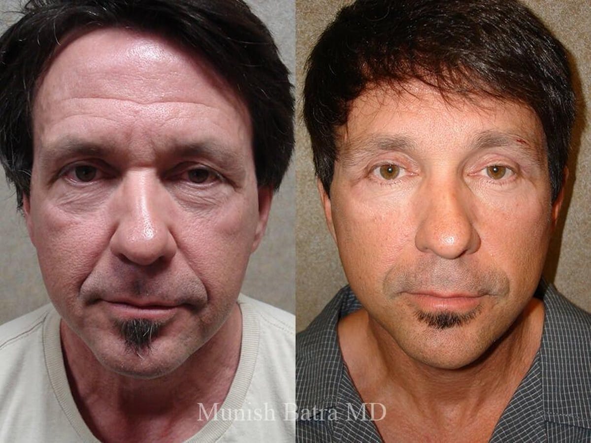 Facelift Before & After Gallery - Patient 405200 - Image 1