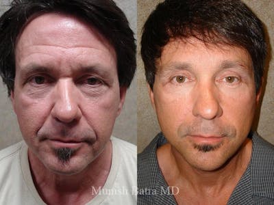 Facelift Before & After Gallery - Patient 405200 - Image 1