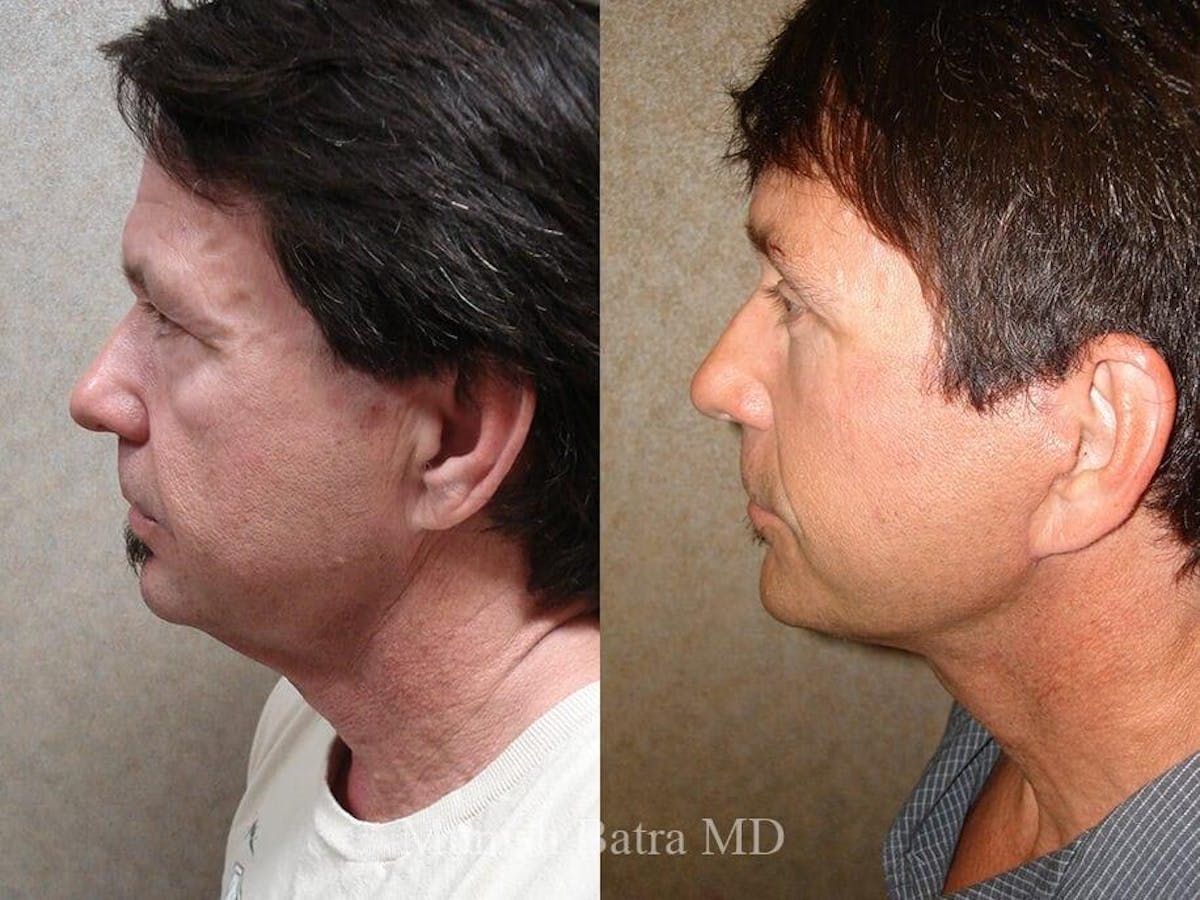 Facelift Before & After Gallery - Patient 405200 - Image 2