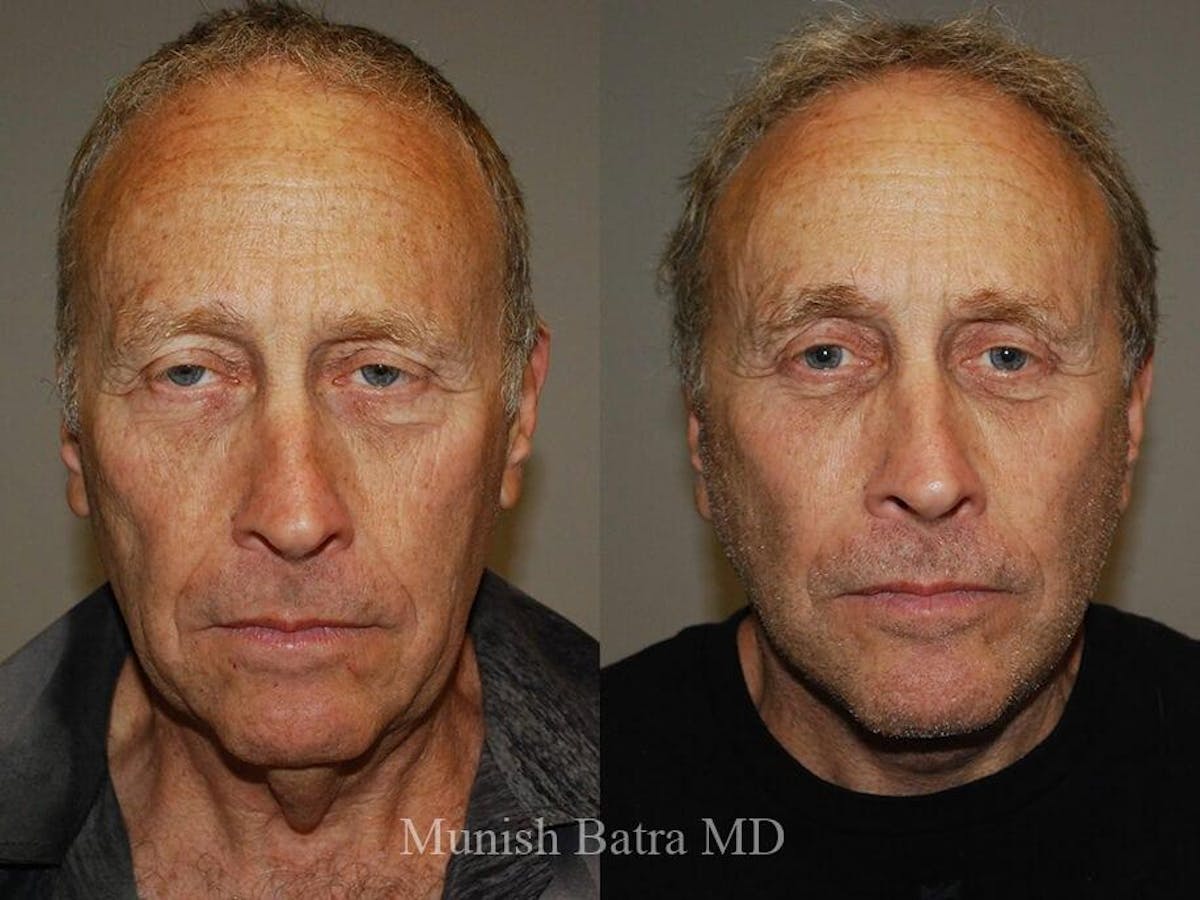 Facelift Before & After Gallery - Patient 245464 - Image 1