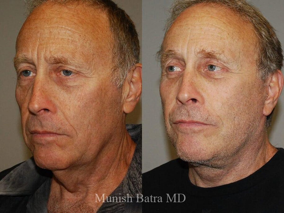Facelift Before & After Gallery - Patient 245464 - Image 2